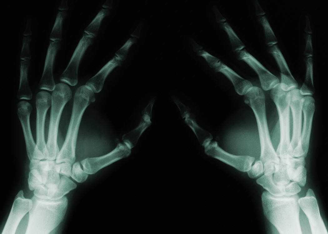 Hand Xray